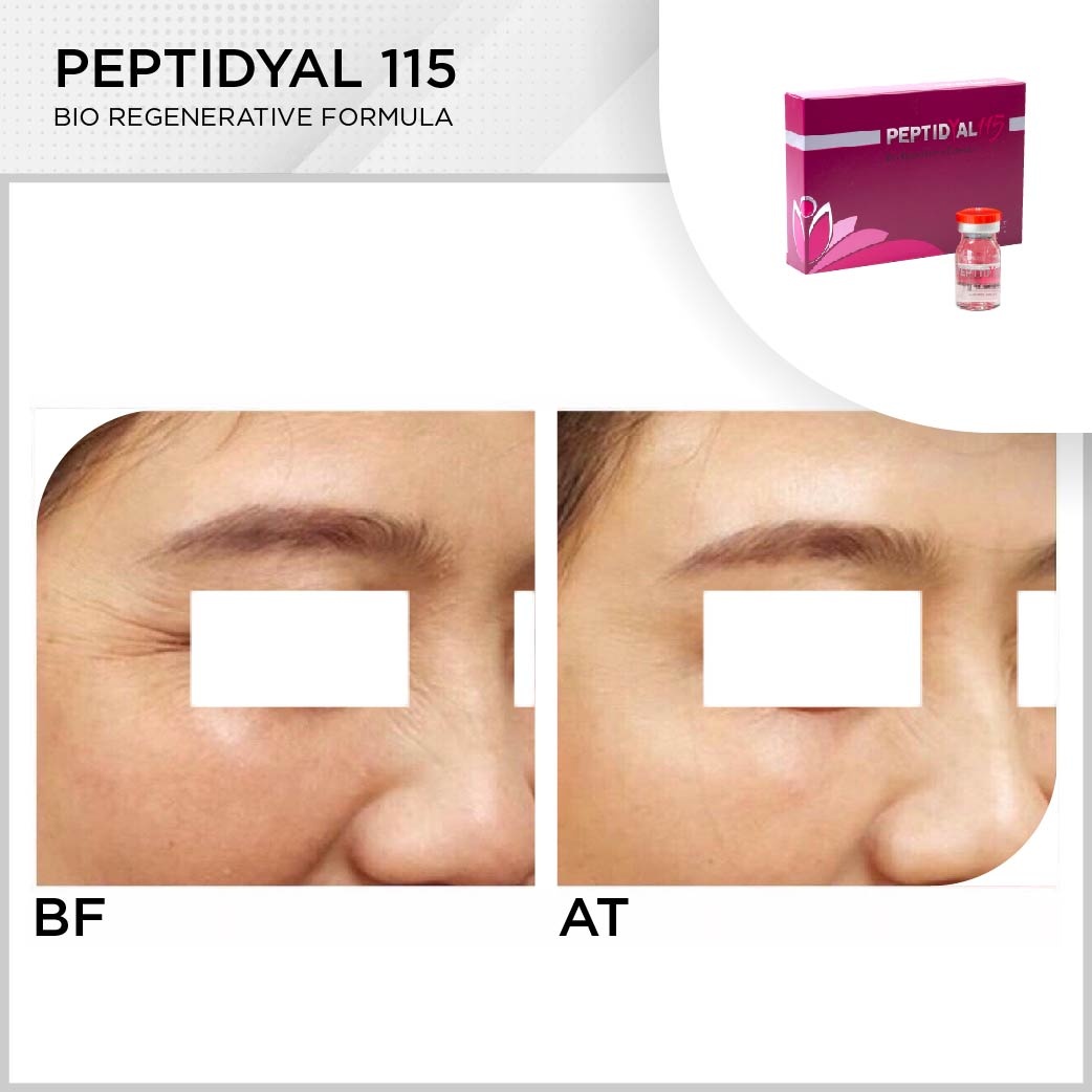 Peptidyal 115 – Meso cocktailvev